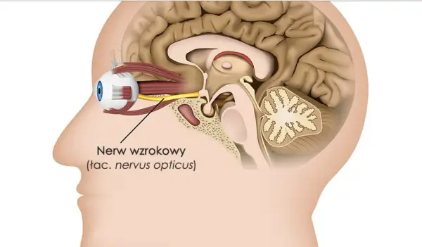 Schematyczny przekrój głowy ukazujący oko i nerw wzrokowy. Uszkodzony nerw wzrokowy może wymagać operacji.
