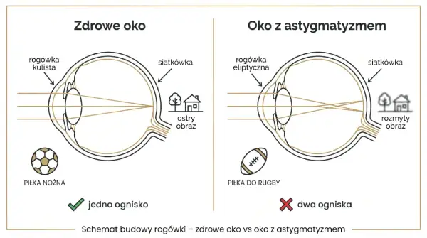 Zdrowe oko z kulistą rogówką skupia światło na siatkówce, dając ostry obraz piłki nożnej. Oko z astygmatyzmem i eliptyczną rogówką tworzy dwa ogniska, rozmywając obraz.
